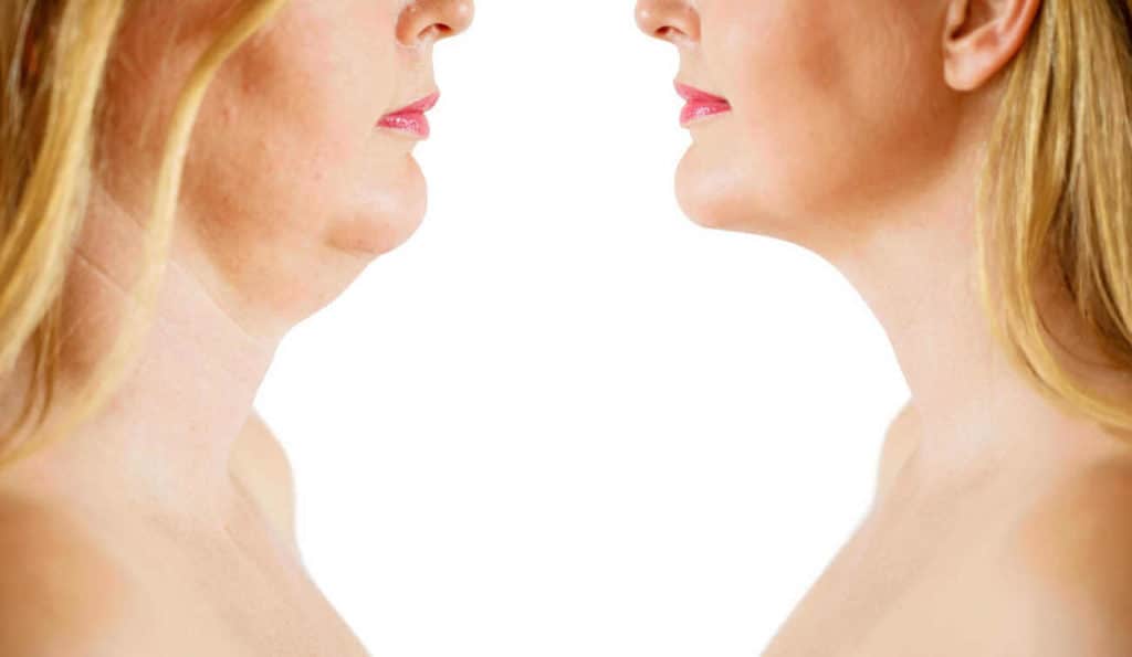Double Chin treatment Swansea before and after results