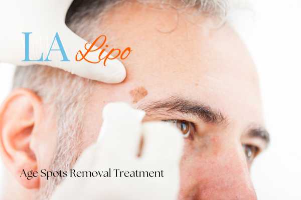 What Are the Most Effective Treatments for Age Spots Swansea?