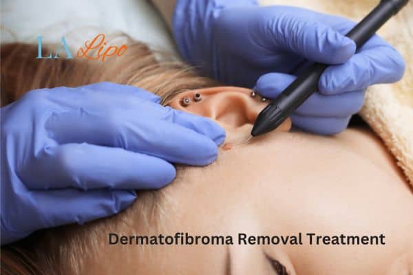 Dermatofibroma Removal Treatment Swansea