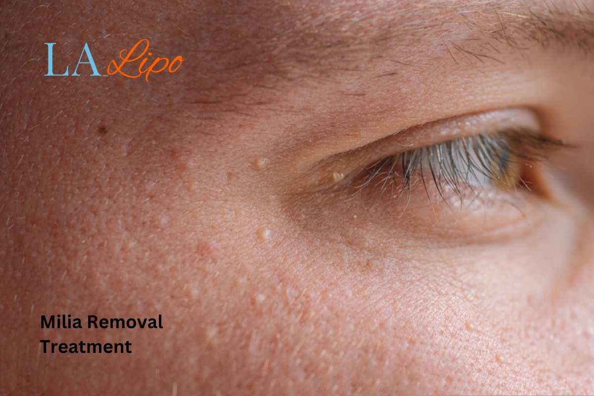 Cryopen Milia Removal: Is It the Easiest and Safest Option Swansea?