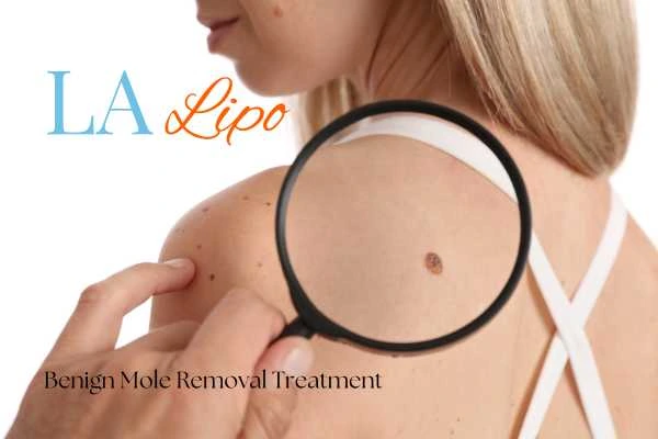 Why getting moles removed Swansea can boost your confidence!