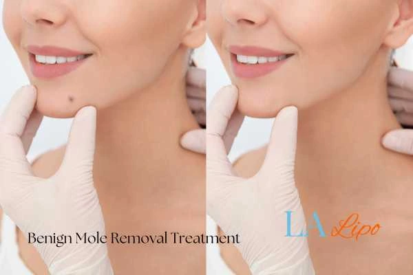 woman's before and after mole removal Swansea results
