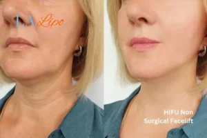 hi-fu for wrinkles Swansea before and after results