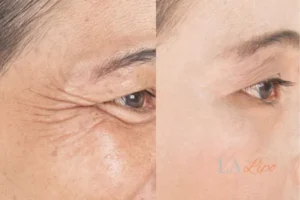 Before and after results of woman - HI-fu wrinkles reduction treatment Swansea