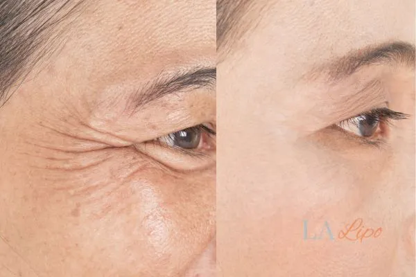 Before and after results of woman - HI-fu wrinkles reduction treatment Swansea