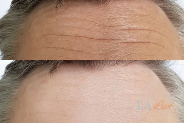 results of HIFU Swansea on mans forehead to help reduce lines and wrinkles