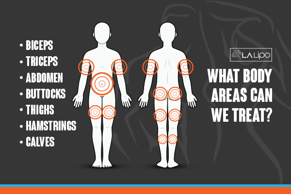 Graphic to show areas you can have LA-EMS Body Sculpting Swansea treatment.