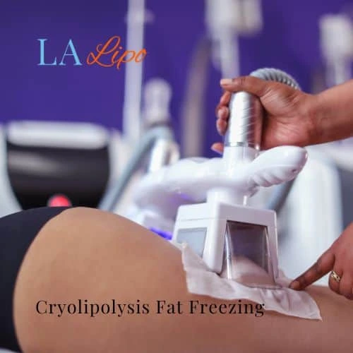 fat freezing - Cryolipolysis Swansea