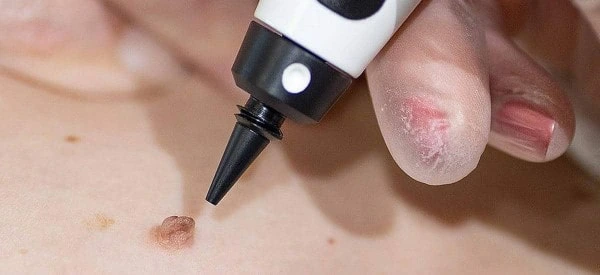 skin tag removal using cryopen Swansea