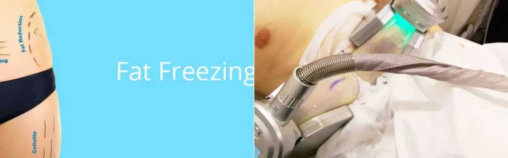 Fat freezing Swansea on multiple areas of the body