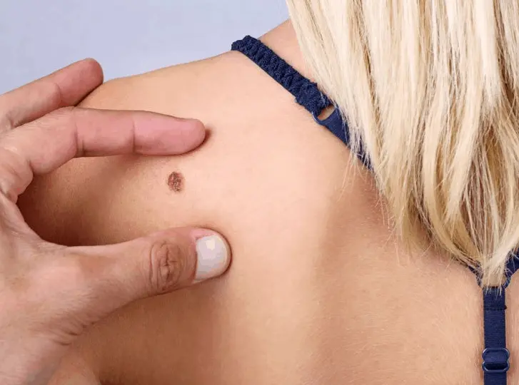 woman having mole removal Swansea consultation before treatment.