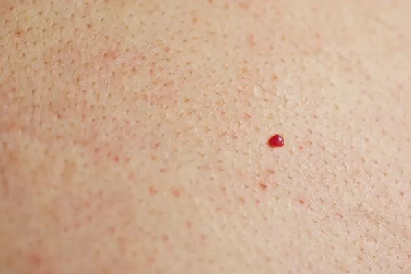 close up of a cherry angioma Swansea