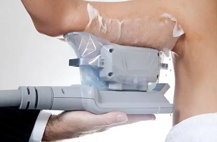 Picture of fat freezing Swansea on the upper arms.