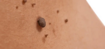 image of a skin tag Swansea