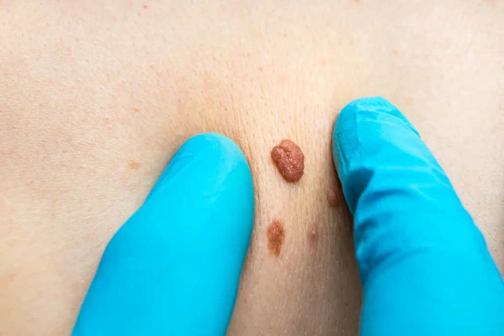 Consultant examining a skin tag Swansea