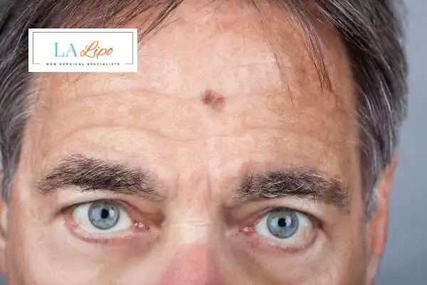 Solar Lentigo Removal Swansea image of man with mark on his forehead