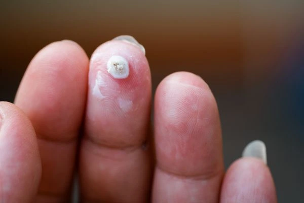 wart on person finger - cryotherapy to treat from LA LIPO Swansea