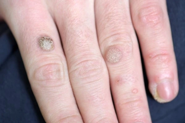 photo of warts on person hand - see wart removal Swansea from LA LIPO