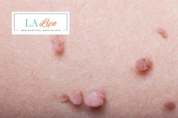 Does cryopen skin tag removal Swansea hurt? Find out now call our team today!