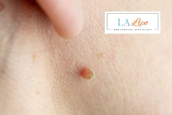 Book skin tag removal Swansea today speak to our team now!