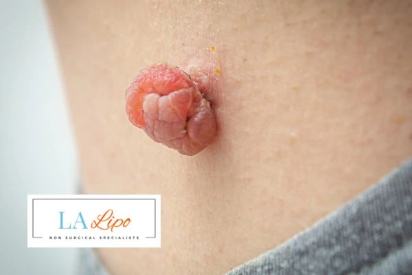 Interested in skin tag removal Swansea? Concerned about the pain? Find out more today!