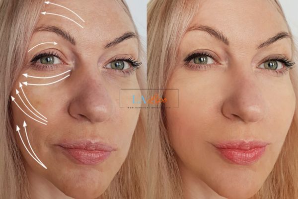 Morpheus 8 results Swansea face lift.