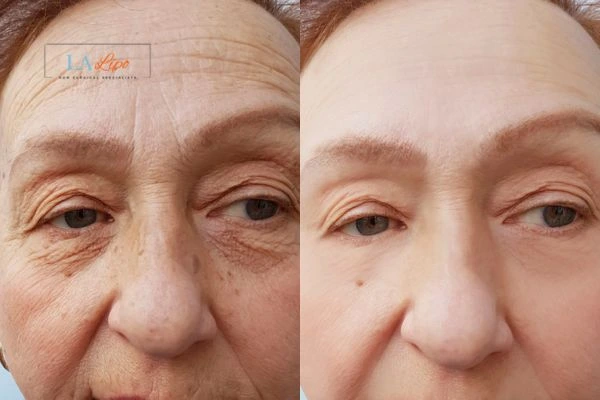 The powerful benefits of Morpheus8 Treatment Swansea - Call Our team today!