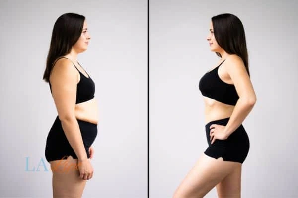 Picture of womans before and after using LA-EMS body sculpting to improve her core strength Swansea