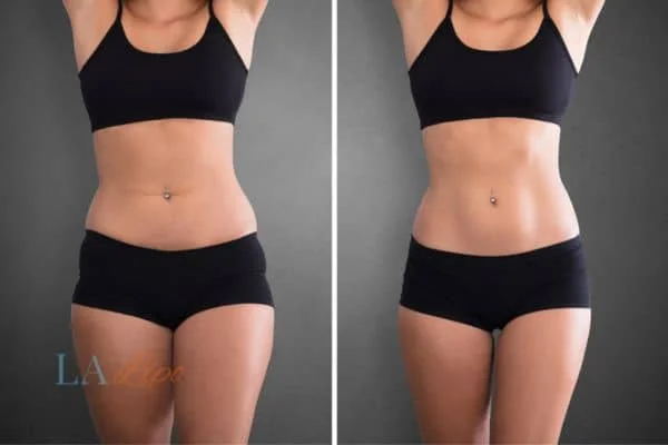 before and after results of non-surgical treatment to help a woman's body image and mental health Swansea