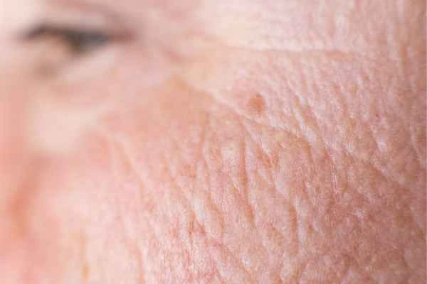 close up picture of a woman's face showing an age spot Swansea