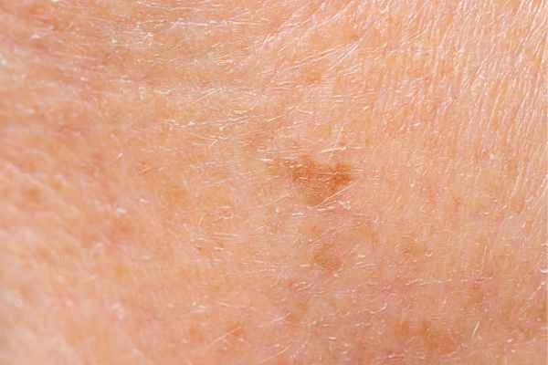 close up picture of age spots Swansea