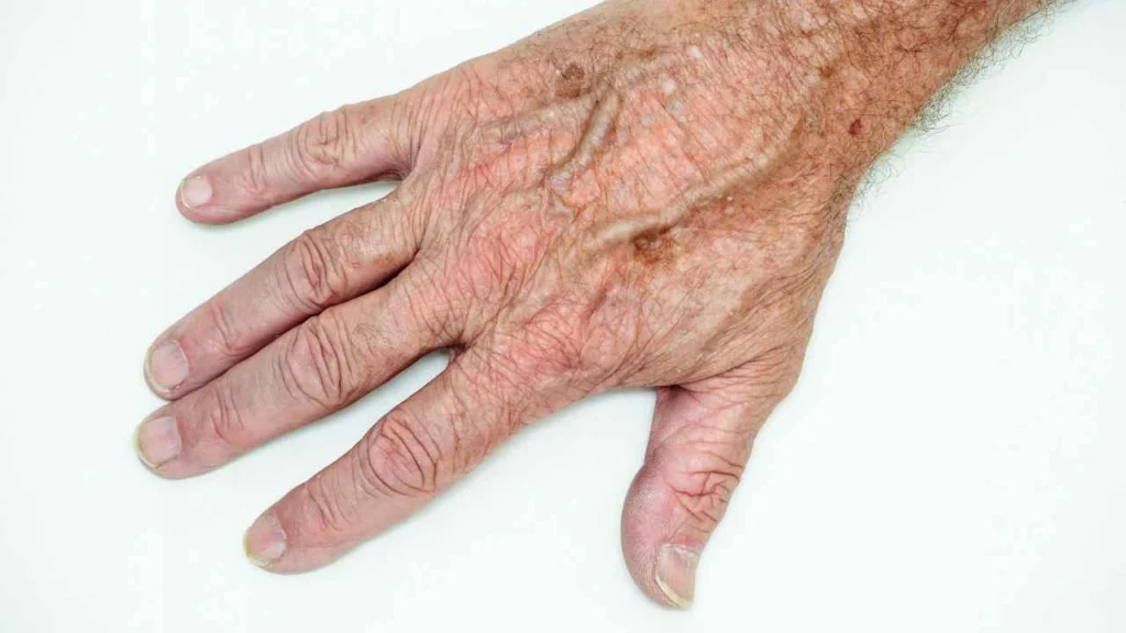 Male hand showing age spot Swansea