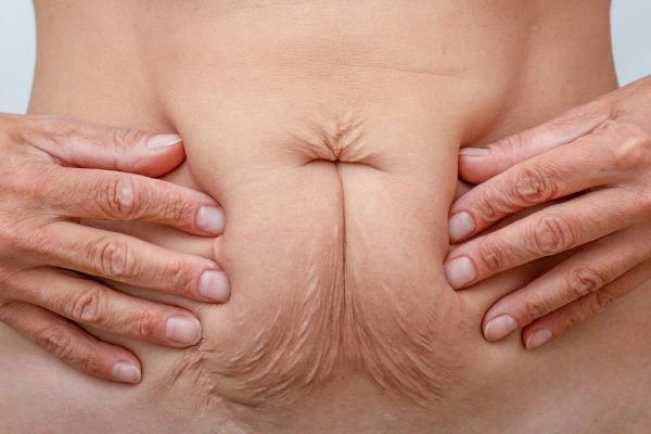 Image of a woman's stomach with loose skin - example of skin tightening Swansea options