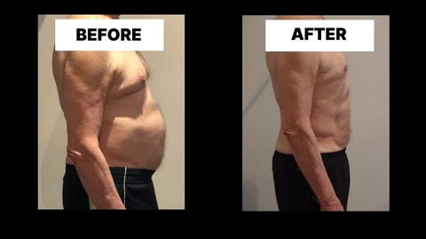 What Symptoms Can Diastasis Recti Cause in Men? Weak Core, Back Pain and Poor Posture Swansea